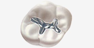 Dental amalgam.